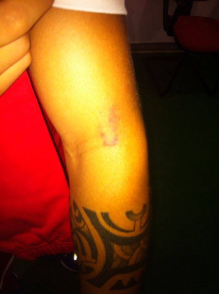 Следы от укуса на руке Джузеппе Де Луки