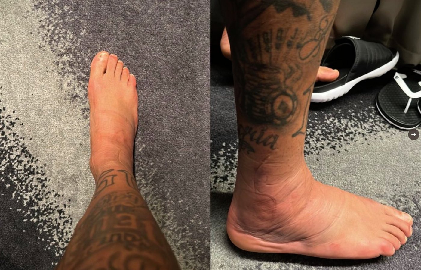 Нога Неймара после матча с сербами